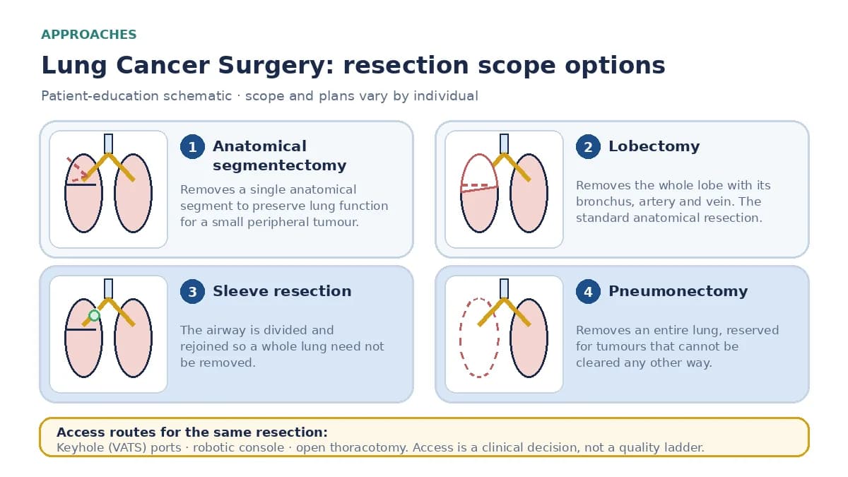 Medical infographic comparing anatomical segmentectomy, lobectomy, sleeve resection reconstructing the airway to avoid removing a whole lung, and pneumonectomy, alongside keyhole, robotic and open access routes.
