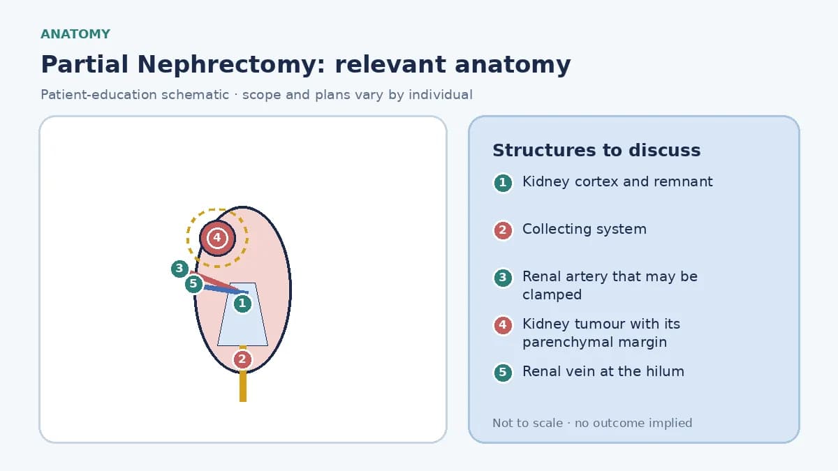 Medical illustration of kidney anatomy for partial nephrectomy: cortex, collecting system and hilum, a polar tumour with its planned parenchymal margin, and the artery that may be clamped during excision.