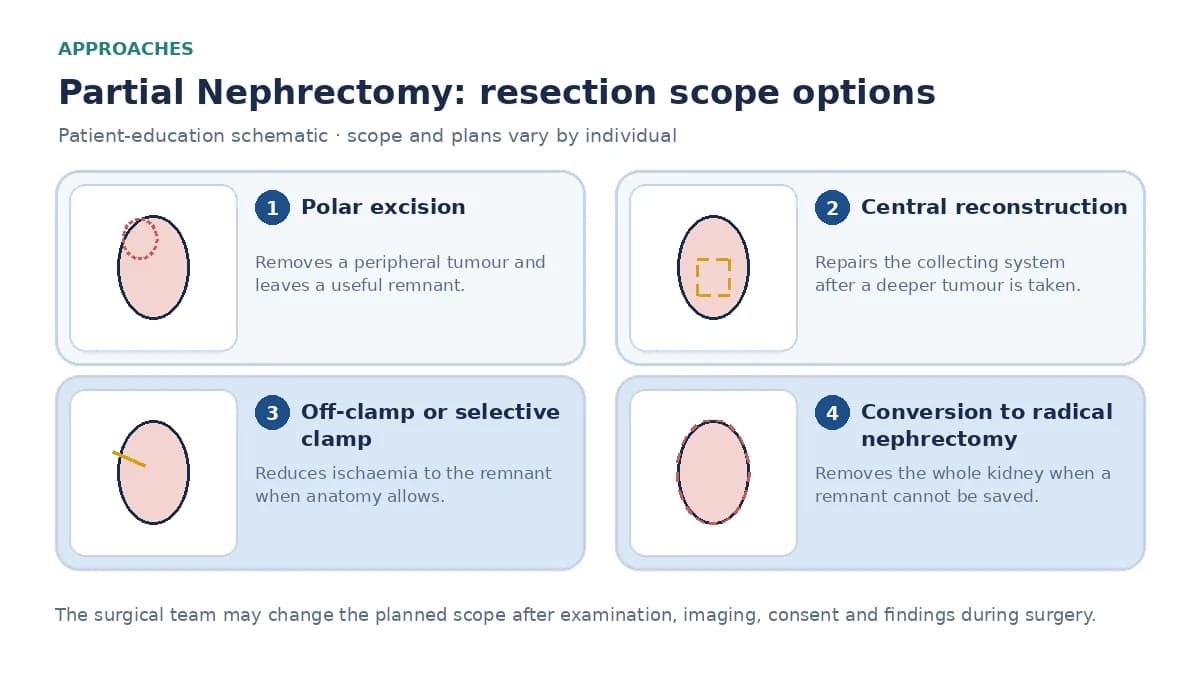 Medical infographic comparing polar excision with a preserved remnant, central tumour reconstruction with collecting-system repair, off-clamp technique, and conversion to radical nephrectomy when a remnant cannot be saved.