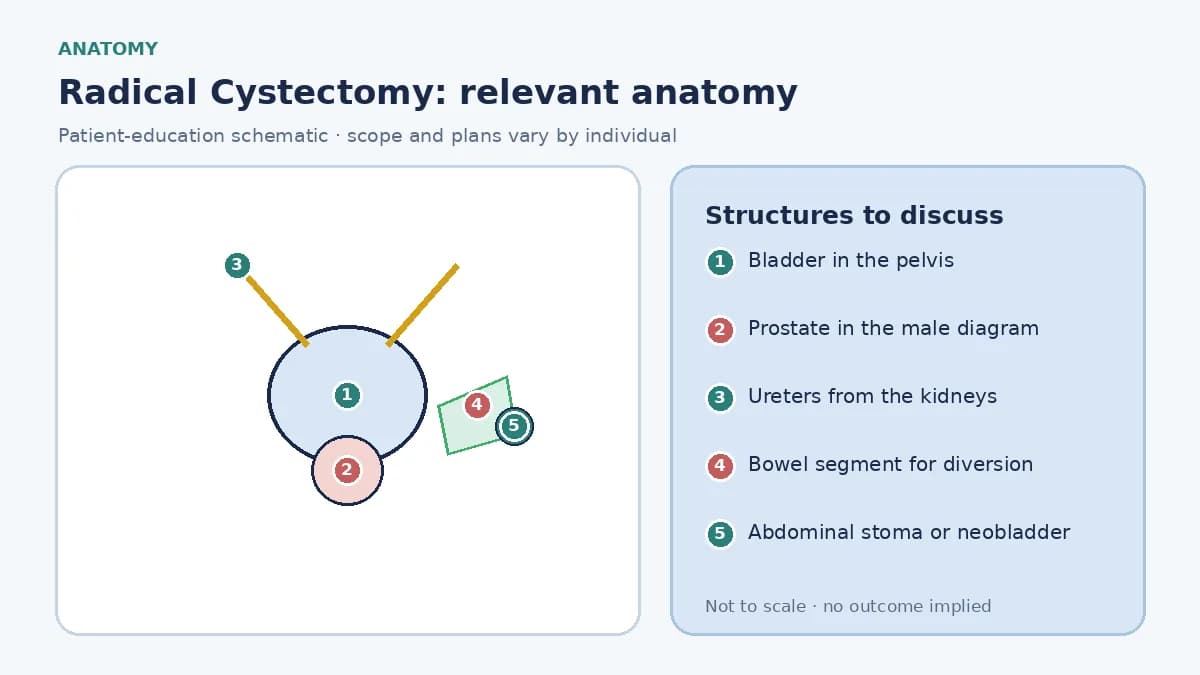 Medical illustration of pelvic anatomy for radical cystectomy: bladder behind the pubic bone, ureters, prostate in the male diagram, and a small-bowel segment prepared for urinary diversion.