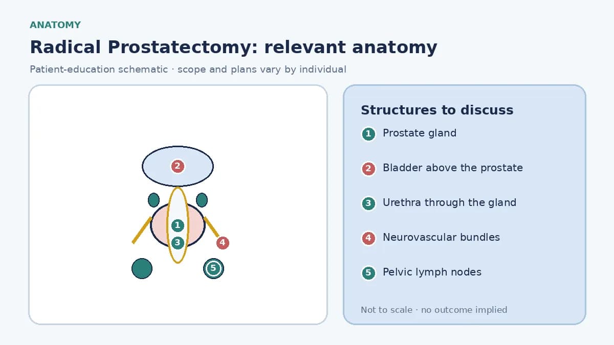 Medical illustration of prostate anatomy for cancer surgery: prostate below the bladder, seminal vesicles, urethra, the neurovascular bundles along each side, and the pelvic nodes sometimes removed for staging.