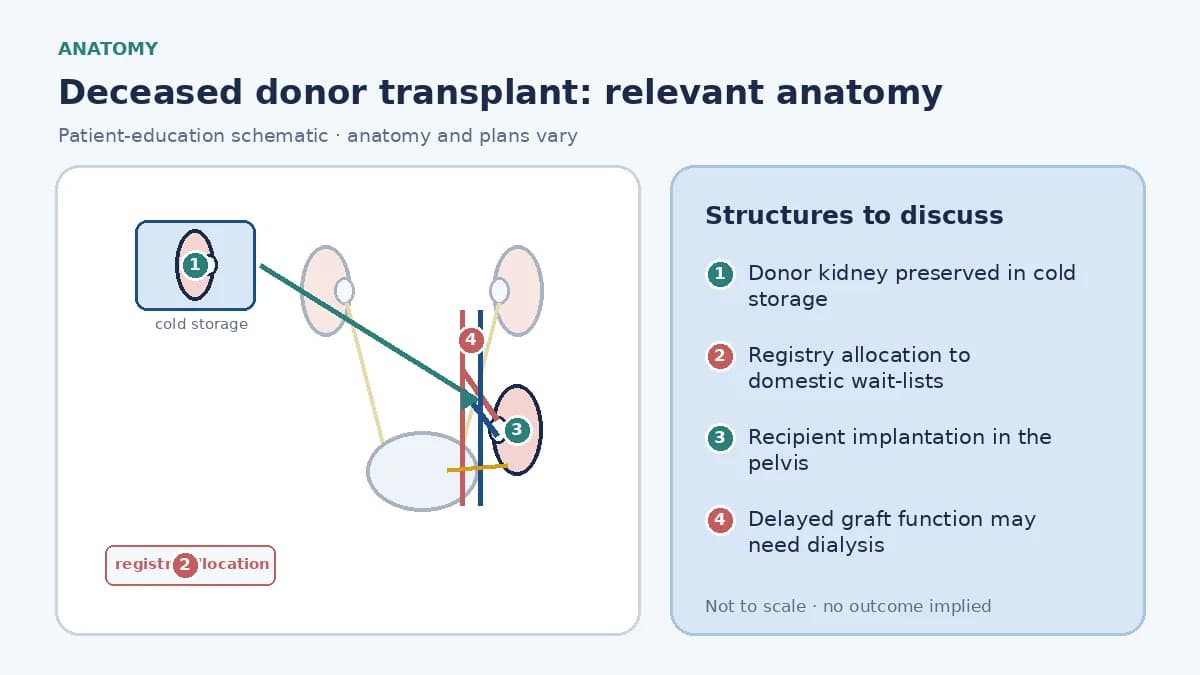 Medical infographic of deceased donor kidney transplantation anatomy showing a preserved donor kidney in cold storage and its implantation in the recipient's lower abdomen joined to the iliac vessels and bladder