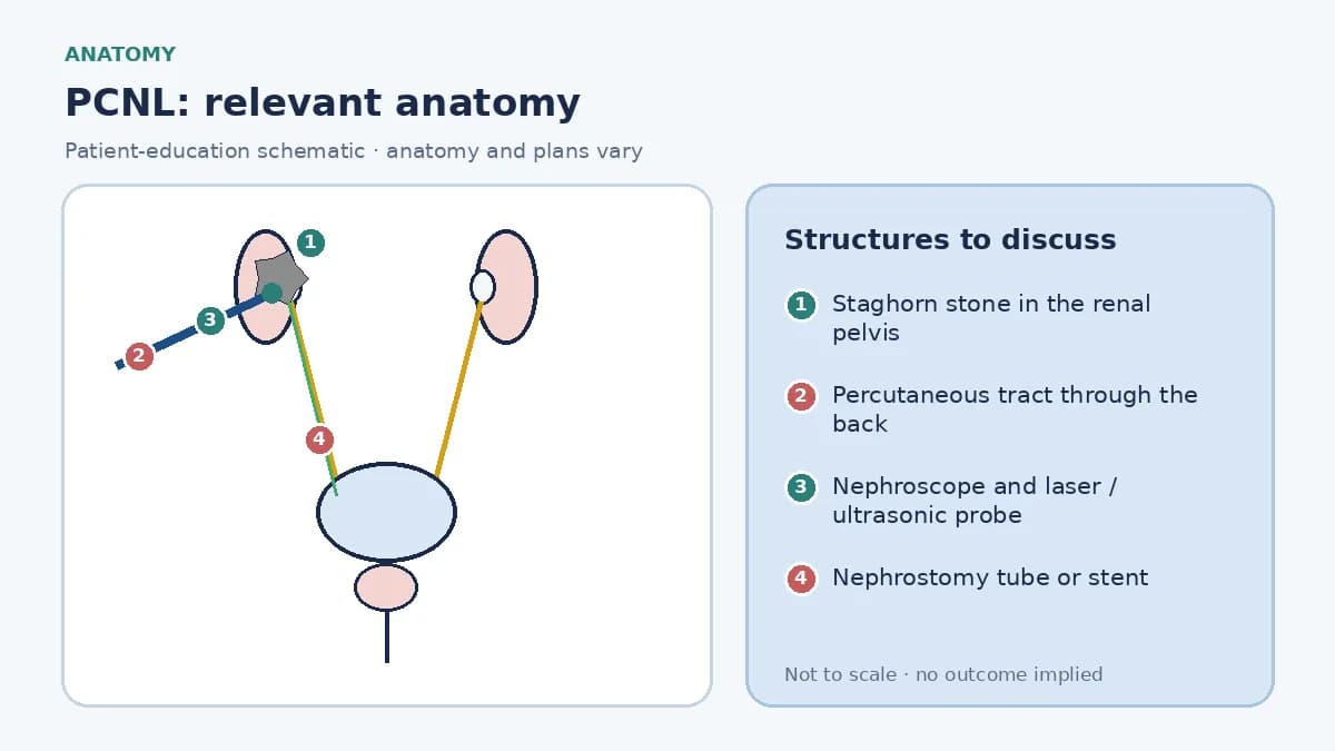 Medical infographic of PCNL anatomy showing a kidney with a large staghorn stone in the renal pelvis and calyces, a percutaneous tract through the back and a nephroscope reaching the stone