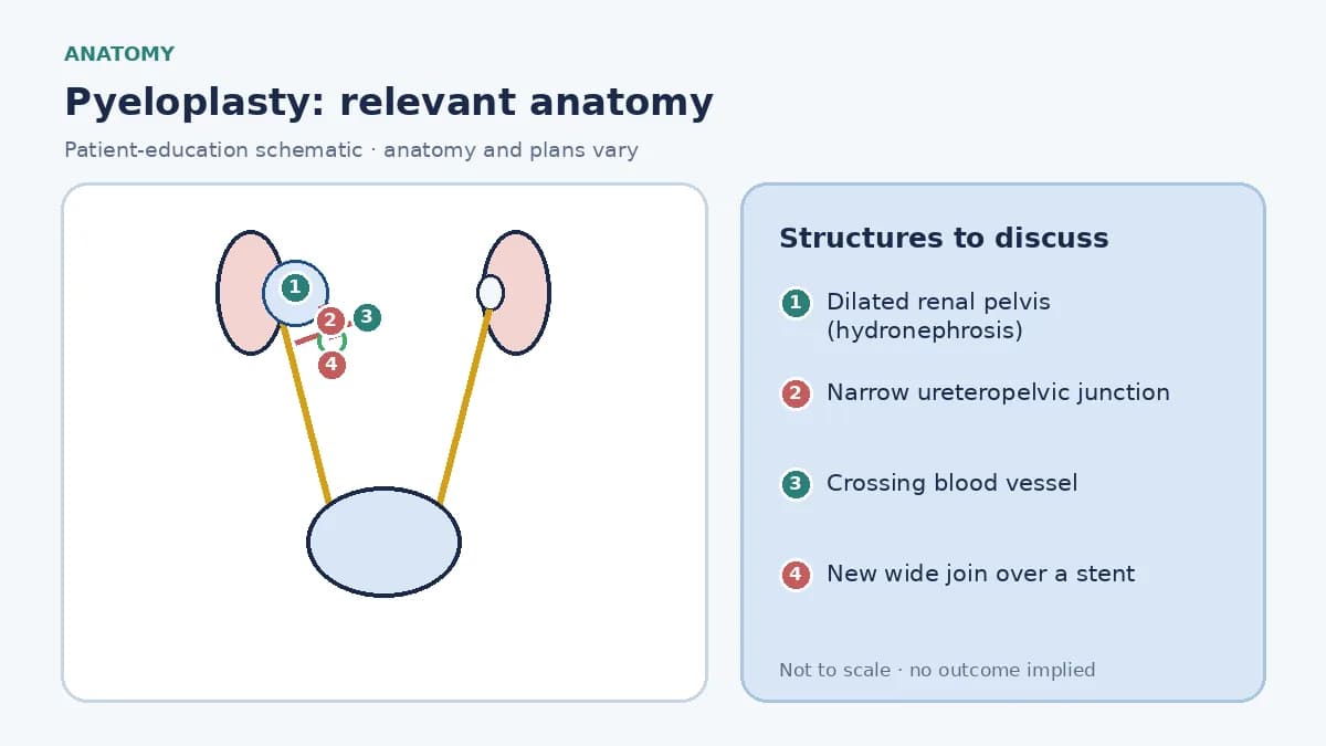 Medical infographic of pyeloplasty anatomy showing a kidney with a dilated renal pelvis narrowing at the ureteropelvic junction, a crossing vessel and the normal ureter below