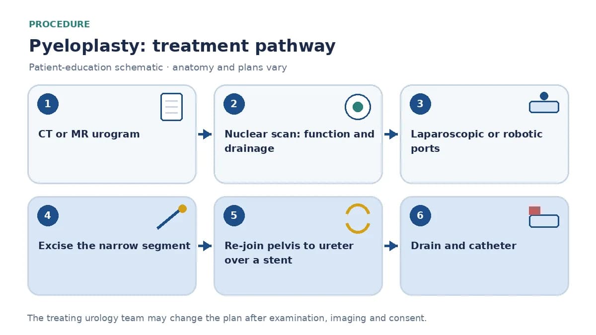 Step-by-step pyeloplasty pathway infographic showing CT or MR urogram, nuclear renal scan, laparoscopic or robotic port placement, excision of the narrowed segment, re-joining pelvis to ureter over a stent and drain placement