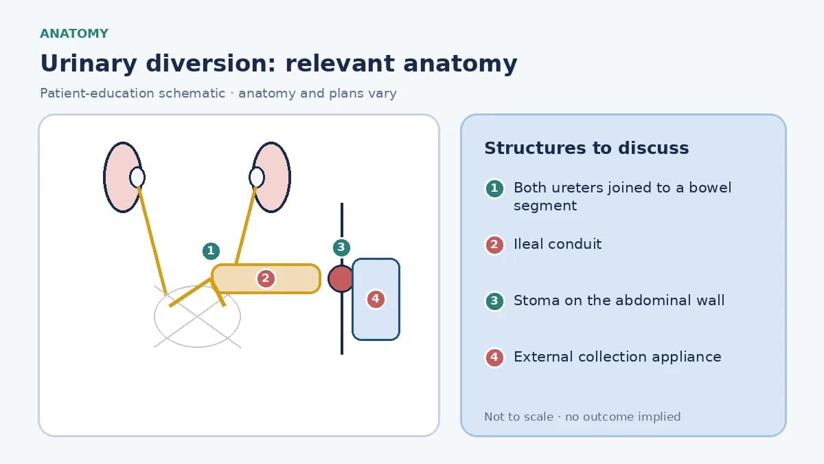 Medical infographic of urinary diversion anatomy showing both ureters joined to an isolated segment of small bowel that passes through the abdominal wall to a stoma with an external collection appliance