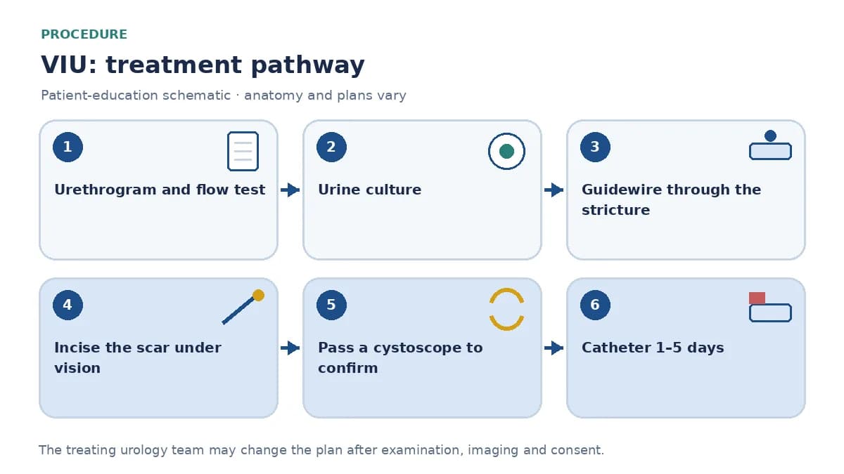 Step-by-step VIU pathway infographic showing urethrogram and flow test, urine culture, guidewire passage through the stricture, cold-knife or laser incision of the scar, cystoscope passage and catheter placement