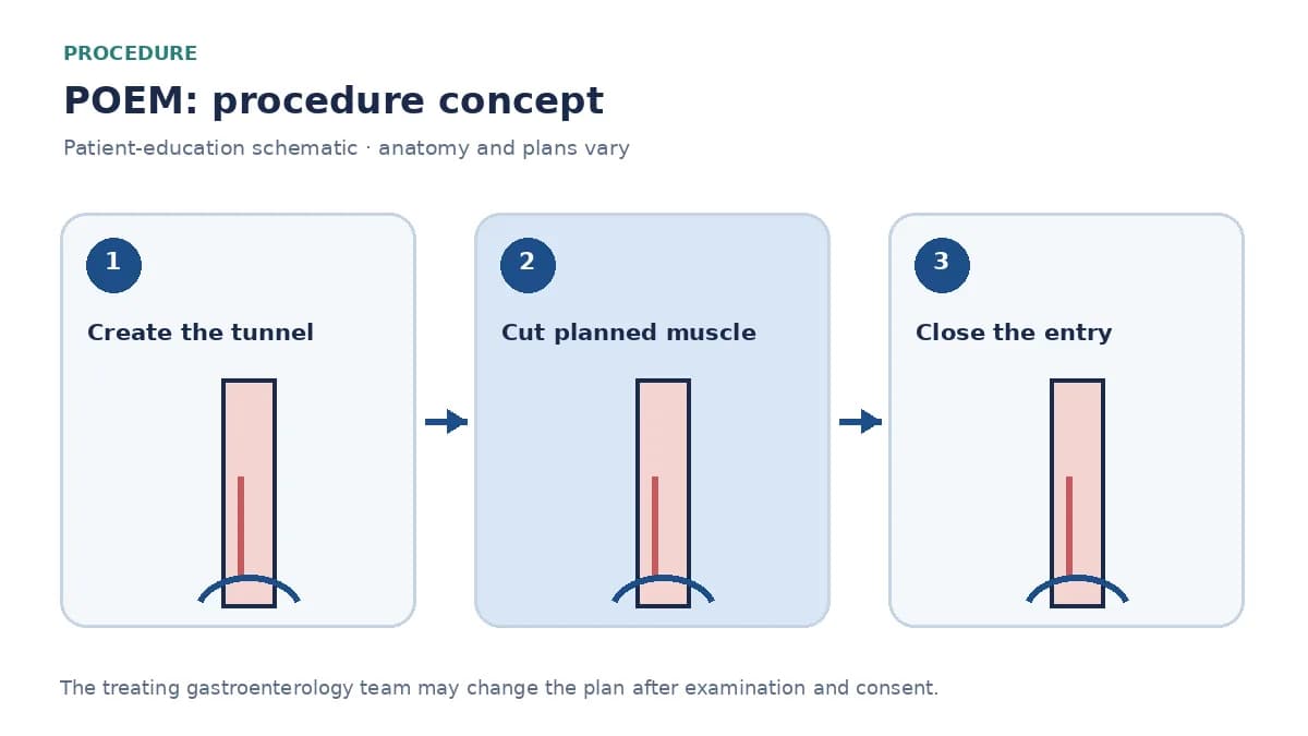 Clinical diagram of a submucosal tunnel and circular-muscle myotomy during POEM