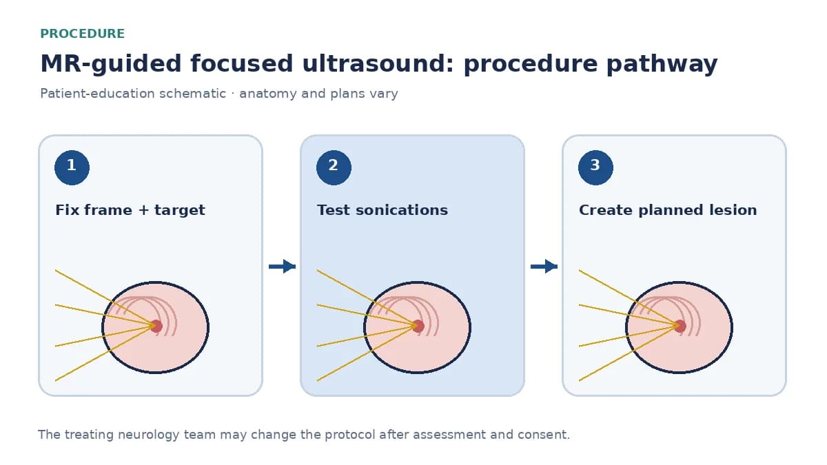 Numbered MRgFUS pathway showing frame placement, test sonications and monitored incisionless thalamotomy