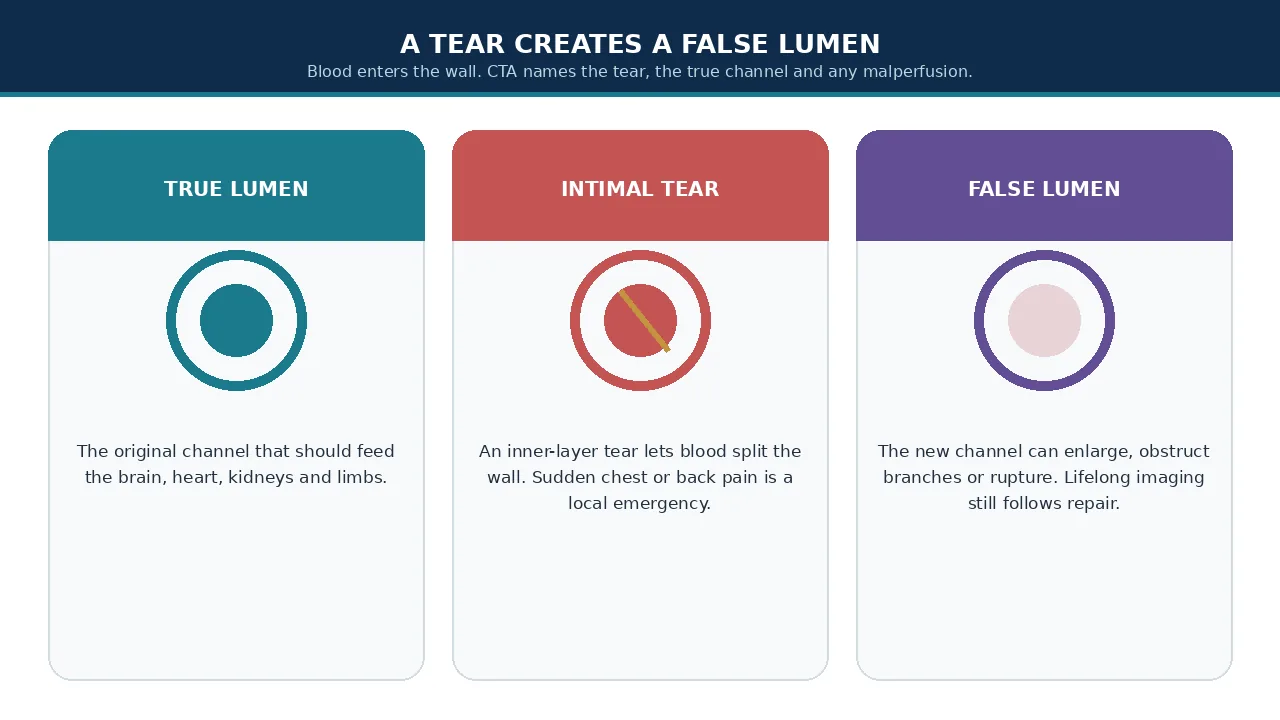 Educational illustration of true lumen, intimal tear and false lumen