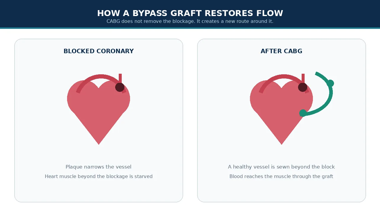 Blocked coronary artery beside a completed bypass graft