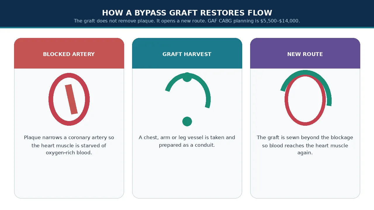 Educational illustration of a blocked coronary artery, graft harvest and the new route around the blockage
