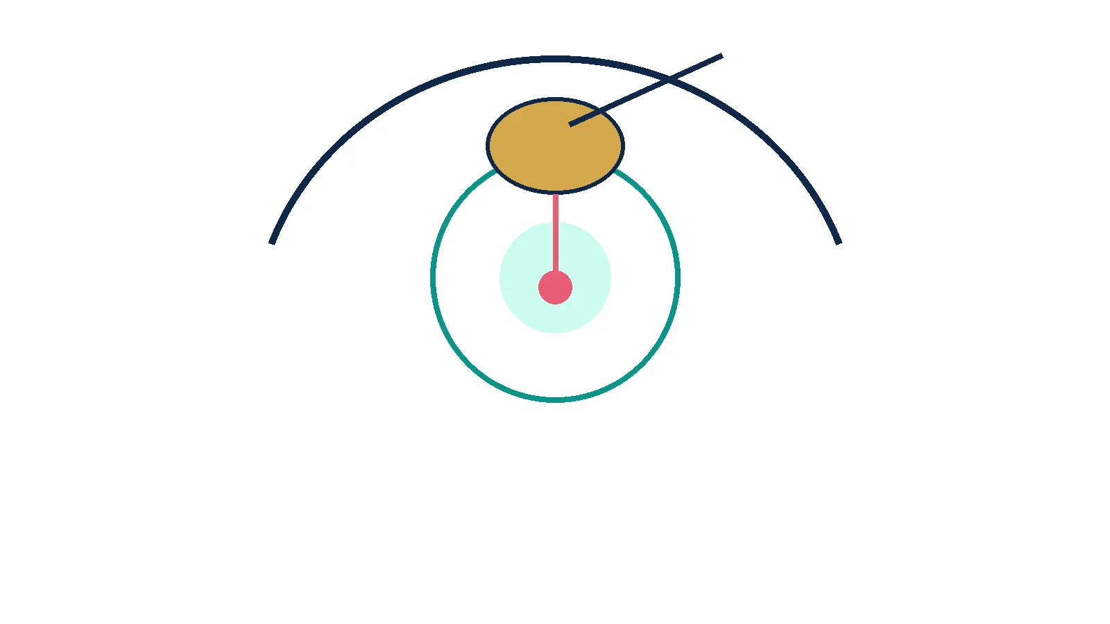 Diagram of an implanted ventricular reservoir used for repeated CSF access