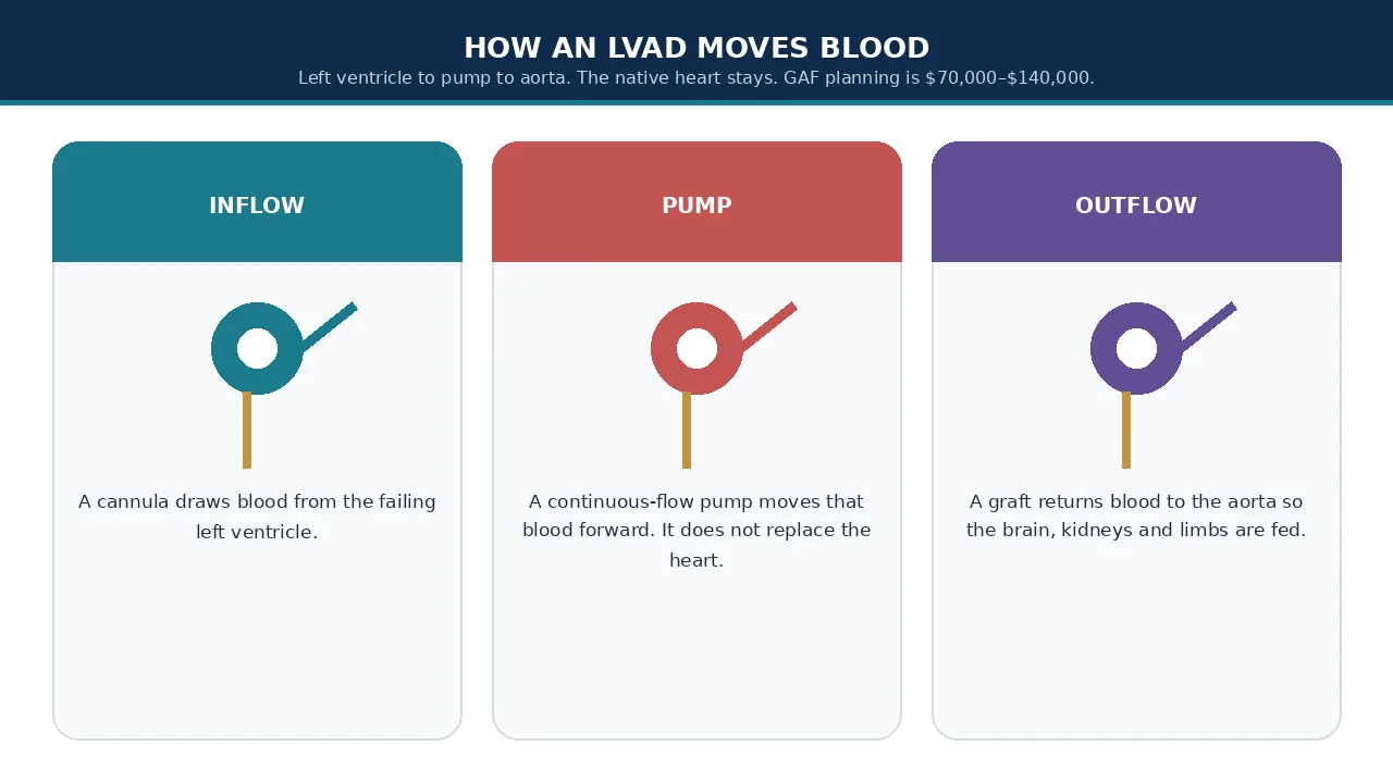 Educational illustration of LVAD inflow, pump and outflow