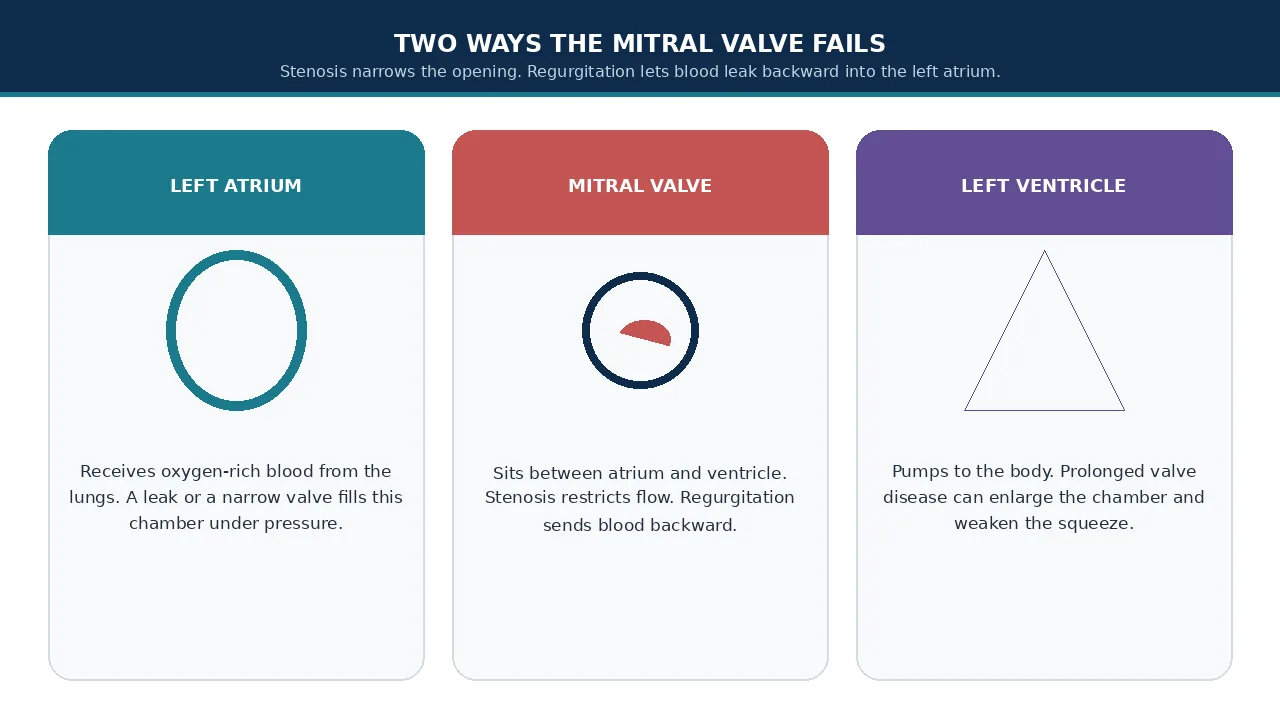 Educational illustration of left atrium, mitral valve and left ventricle